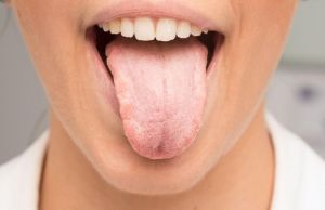 Cum sa tratezi gura uscata. Metode naturale