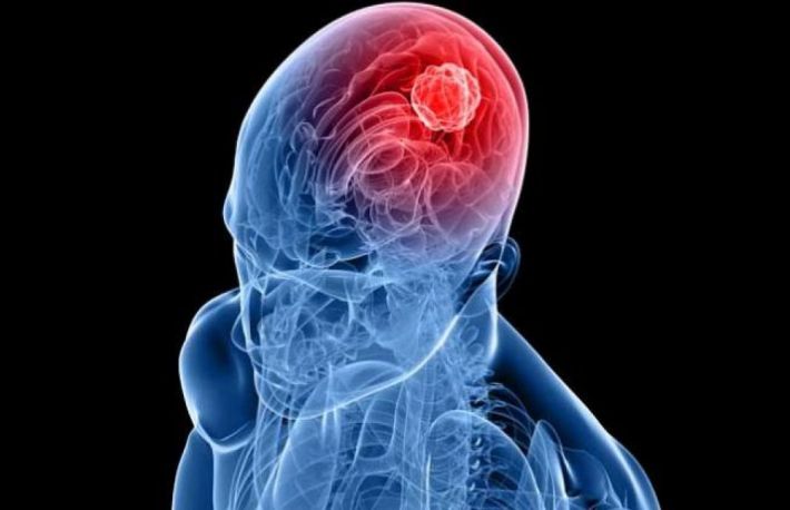 Simptomele unei tumori cerebrale