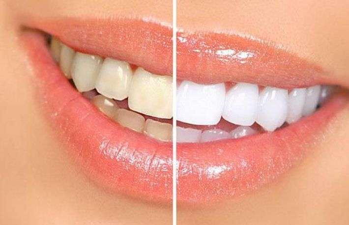 Cum sa reduci  tartrul dentar. Metoda naturala