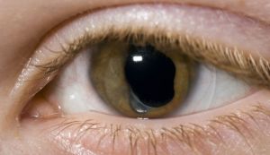 Cum se poate depista cataracta? Simptome