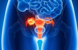 Cum sa recunosti CANCERUL OVARIAN. 4 simptome de care trebuie sa tii cont