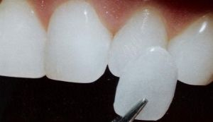 Cum se produc fatetele dentare?