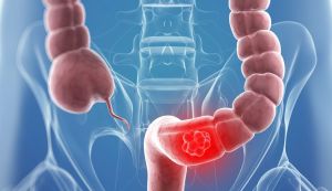 Care sunt simptomele cancerului de colon